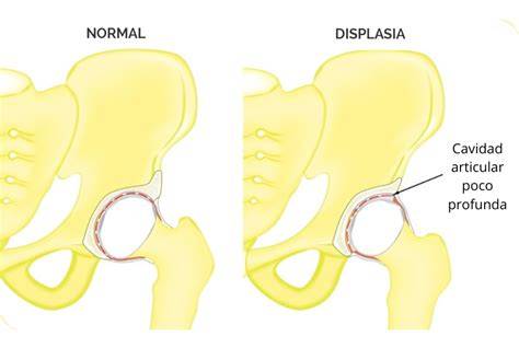 Displasia De Cadera