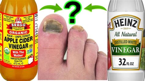 Distilled Vinegar Toenail Fungus