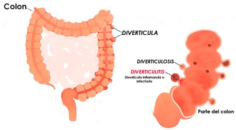 Diverticulitis En Español