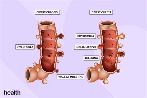 Diverticulosis Vs Diverticulitis