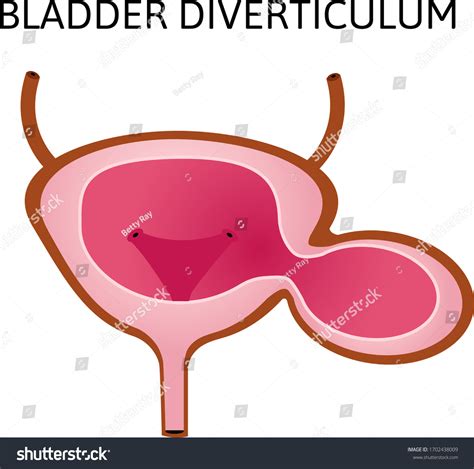 Diverticulum On Bladder