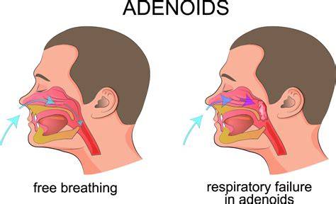 Do Adenoids Grow Back