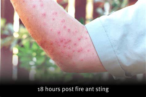 Do Ant Sting