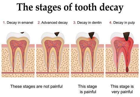 Do Cavities Hurt