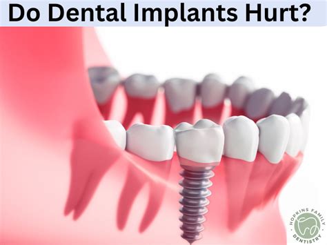 Do Dental Implants Hurt