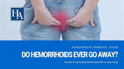 Do External Hemorrhoids Go Away