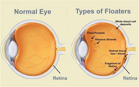 Do Eye Floaters Go Away