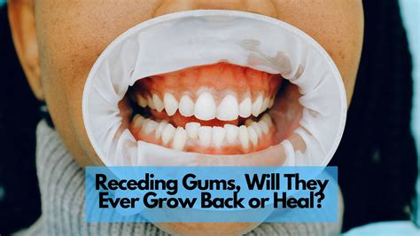 Do Gums Grow Back
