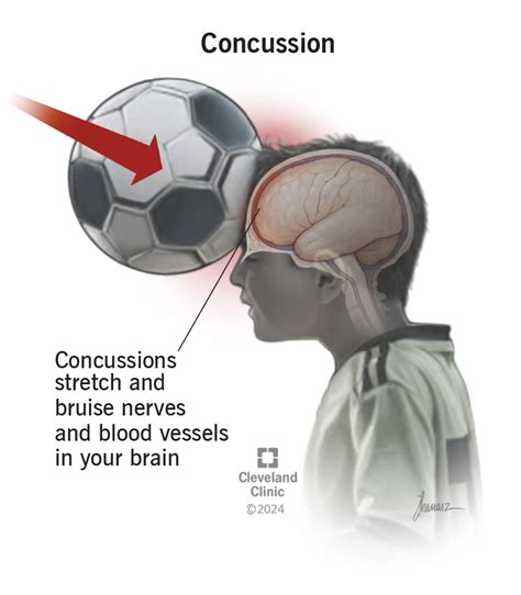 Do I Have A Concussion