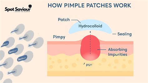 Do Pimple Patches Work