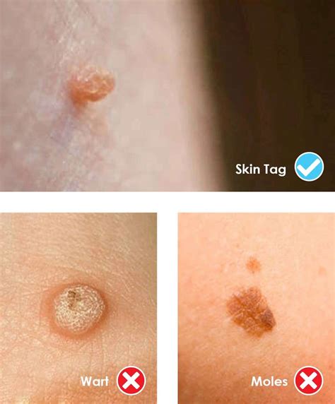 Do Skin Tags Grow Back