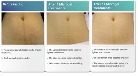 Do Stretch Marks Go Away