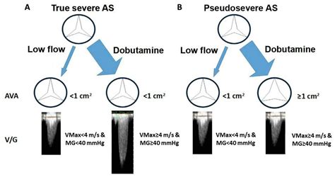 Dobutamine Stress Test