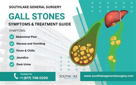 Doctor For Gall Stones
