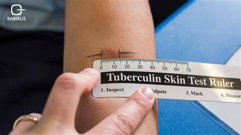 Does A Tb Test Hurt