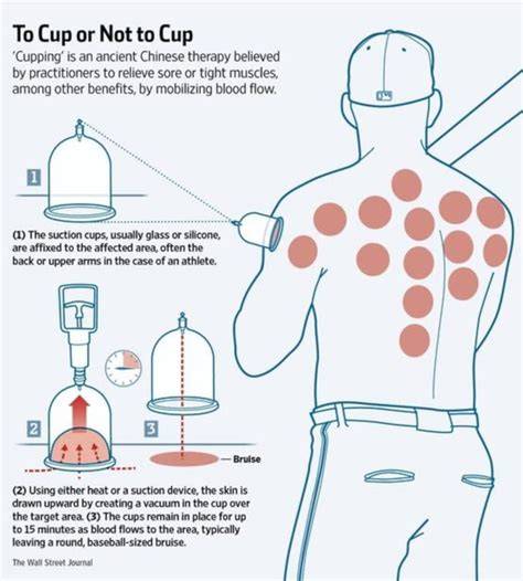 Does Cupping Work