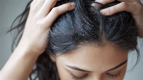 Does Dandruff Itch