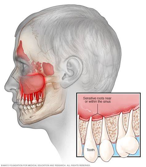 Does Sinusitis Cause Teeth Pain