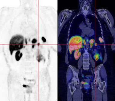 Dotatate Pet Scan