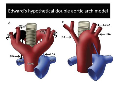 Double Aortic Arch