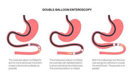 Double Balloon Enteroscopy