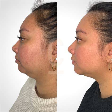 Double Chin Fat Removal