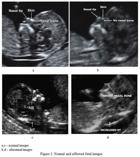 Downs Syndrome On Ultrasound
