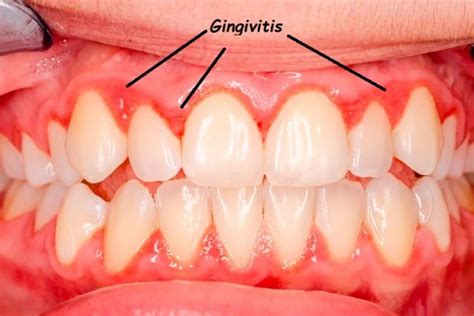 Drugs For Gingivitis