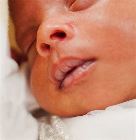 Dry Chapped Lips On Newborn