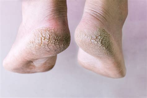 Dry Cracked Feet