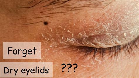 Dry Skin Around Eyes