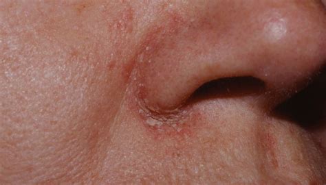 Dry Skin Around Nose