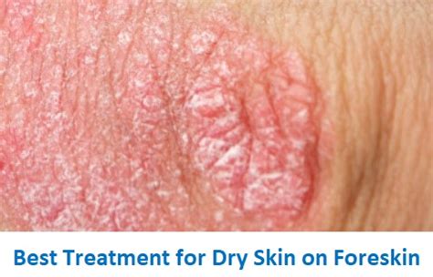 Dry Skin On Penis
