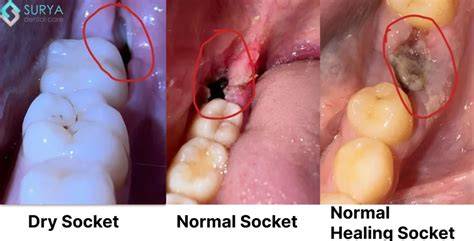 Dry Socket Vs Normal Socket
