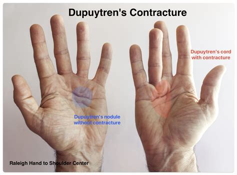 Dupuytren's Contracture Surgery