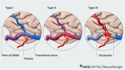 Dural Av Fistula