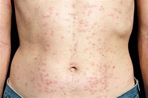 E. Coli Skin Infection