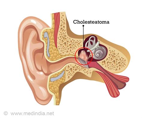 Ear Disease Cholesteatoma