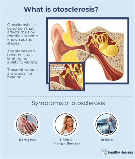 Ear Disease Otosclerosis