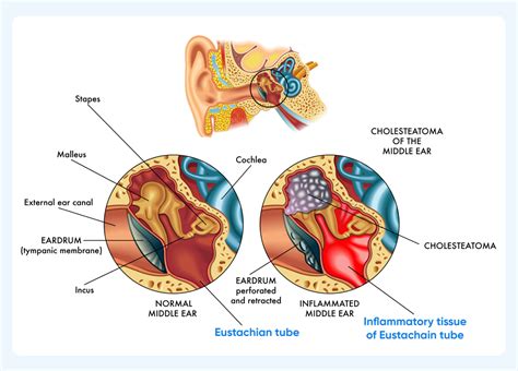Ear Infection Contagious