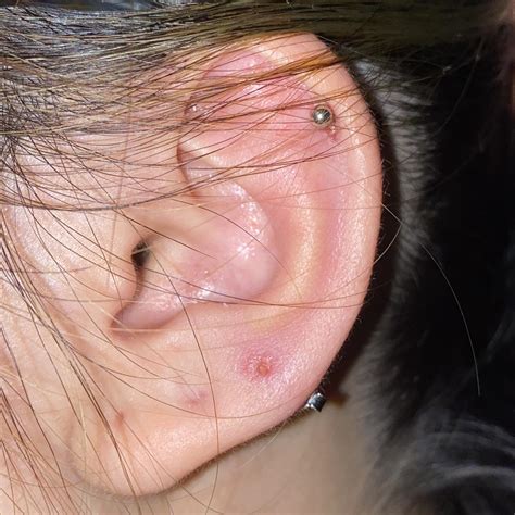 Ear Infection Earring Hole