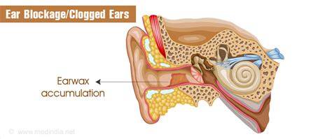 Ear Is Clogged And Painful