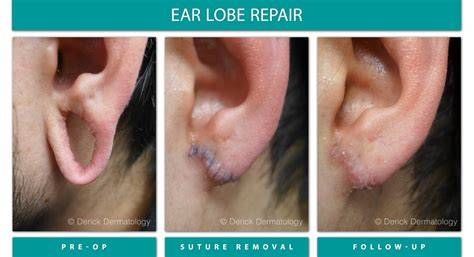 Ear Lobe Repair