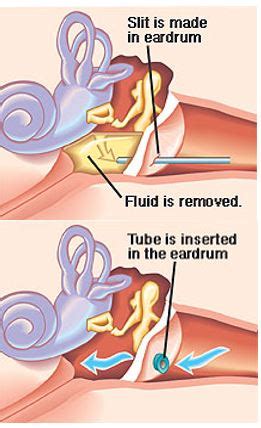 Ear Tube Fell Out