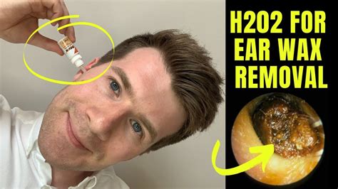 Ear Wax Removal Hydrogen Peroxide