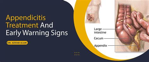 Early Signs Of A Appendicitis