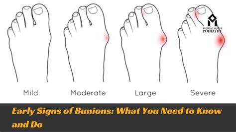 Early Signs Of Bunions