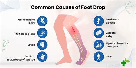 Early Signs Of Foot Drop