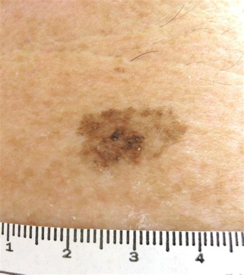 Early Stage Melanoma Pictures