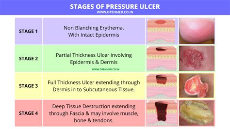 Early Stage Woman Ulcer Symptoms